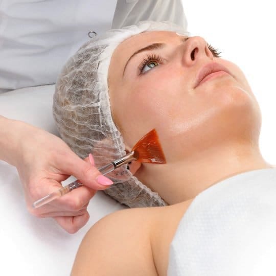 Chemical Peels