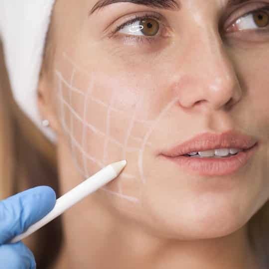 FACIAL FILLERS