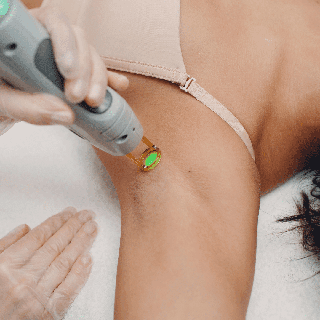 Laser hair reduction clinic treatment, to remove unwanted hair from patient's underarms.